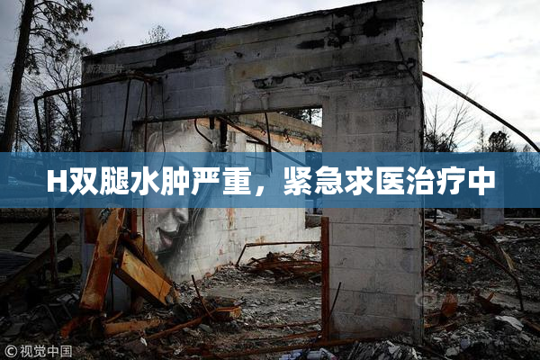 H双腿水肿严重，紧急求医治疗中